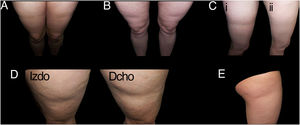 Ejemplos de casos de lipoatrofia semicircular (LS) típica (grupo i). A y B: LS con disposición bilateral y simétrica en banda en cara anterior de muslos. C: LS bilateral y simétrica (en la figura solo se muestra uno de los muslos) en cara externa de muslos (i), con resolución espontánea al año (ii). D: LS en banda en cara externa de ambos muslos, razonablemente simétrica. E: LS unilateral en cara externa de muslo derecho (grupo iu).