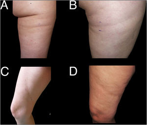 Ejemplos de casos de lipoatrofia en banda en miembros inferiores (grupo ii). A y B: lipoatrofia en banda en cara posterior de muslos, localización no típica de LS (grupo iia). C y D: oblicuas en cara interna del muslo, localización no típica de LS (grupo iib).