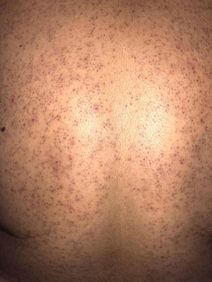 Pápulas foliculares monomórficas en un caso de foliculitis por Malassezia.