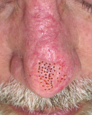 Resultado inmediato tras una sesión de láser de CO2 en la que se realizaron varios puntos focalizados de tratamiento simulando un fraccionado, distribuidos por todo el colgajo y en los bordes de la cicatriz, pero no en la zona deprimida.