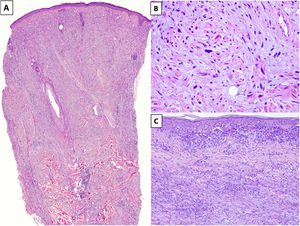 A) Melanoma desmoplásico (MD) infiltrando en profundidad, alcanzando la dermis reticular profunda (HEx20). B) MD con melanocitos fusiformes con algunos núcleos grandes e hipercromáticos, dispuestos de forma aislada y desorganizada en un estroma ligeramente fibromixoide (HEx200). C) MD asociado a un melanoma in situ (HEx200).
