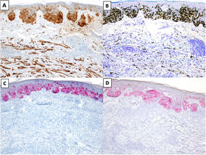 MD asociado a un melanoma in situ de extensión superficial. A) y B). Tinciones inmunohistoquímicas de S100 (x100) y SOX10 (x100): en ambas tinciones se observa positividad en las células del MD y del melanoma in situ. C) y D) Tinciones inmunohistoquímicas de melanA (x100) y HMB-45 (x100): en ambas tinciones se identifica expresión en el melanoma in situ y ausencia de expresión en el MD.