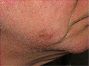 Imagen clínica de un MD. Varón de 62 años que consultó por lesión de crecimiento progresivo en mejilla. Se apreció una lesión en forma de placa marrón clara, indurada de aspecto cicatricial. Se correspondió con un MD puro de 5 mm de espesor.