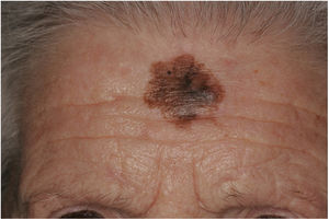 Imagen clínica de un MD asociado a un lentigo maligno (LM). Mujer de 89 años con una lesión en la frente sugestiva de LM. Su exéresis reveló la existencia de un MD asociado que alcanzaba 2,95 mm de grosor.