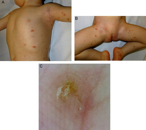 Escabiosis nodular. A, B) Múltiples pápulas y nódulos eritematosos en el tronco, brazos A) y extremidades inferiores B). C) En la dermatoscopia de un surco acarino del pie derecho se evidencia el «signo del ala delta».