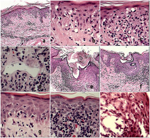 Hallazgos relevantes poco descritos. a) Vacuolización extensa de la capa basal (4×) b) Detalle de vacuolización de la basal (10×) c) Vacuolización de la capa basal con borramiento de la interfase por los linfocitos atípicos (10×). Otros hallazgos frecuentes (d-i). d) Ectasia vascular se observó en todas las etapas evolutivas la MF (10×). e) Dilatación con taponamiento córneo de los infundíbulos (10×) f) Dilatación con taponamiento córneo de los poros de los acrosiringios (10×). g. Vacuolización extensa de la capa basal (10×). h. Extravasación eritrocitaria (10×) i) Espongiosis con microvesiculación asociada a exocitosis de eosinófilos (10×), pápulas y eritrodermia.