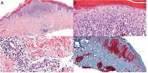 A. Hematoxilina eosina×4. B y C. Hematoxilina eosina×20. D. Inmunohistoquímica CD4×4.