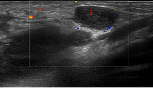 Ecografía inguinal en la que se observa una imagen nodular hipoecogénica compatible con una adenopatía.
