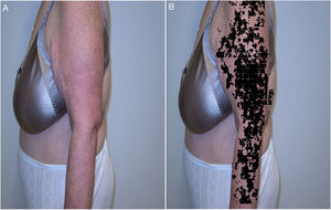 Detección de psoriasis mediante el sistema SkianaPsors. A. Expresión clínica de la psoriasis. B. Detección automatizada de la psoriasis.