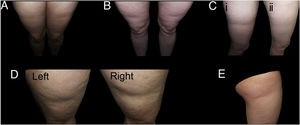 Examples of cases of typical lipoatrophia semicircularis (LS) (Group I). A and B, LS with bilateral, symmetric distribution in bands on the anterior surface of the thighs. C, Bilateral and symmetric LS (only one of the thighs is shown in the figure) on the outside surface of the thigs (i), with spontaneous resolution after a year (ii). D, LS in bands on the outside surface of both thighs, reasonably symmetric. E, Unilateral LS on the outside surface of the right thigh (Group iu).