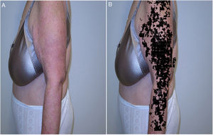 Detection of psoriasis with the SkianaPsors system A, clinical expression of psoriasis B, automated detection of psoriasis.