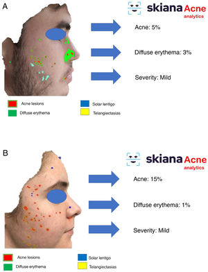 SkianaCare® smartphone application: acne classifier. A. Example of male with mild acne B, example of female with moderate acne.