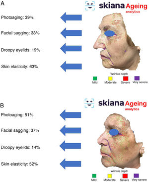 SkianaCare® smartphone application: automated assessment of skin photoaging. A and B, example of 2 women of the same age with different severity of photoaging.