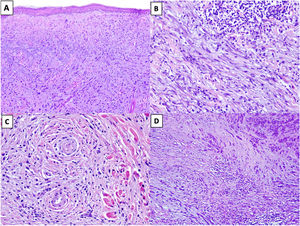 A, DM with actinic elastosis and trapped elastolytic material (hematoxylin-eosin, original magnification ×100). B) DM with a nodular aggregate of lymphocytes (hematoxylin-eosin, original magnification ×200). C, DM with perineural invasion (hematoxylin-eosin, original magnification ×200). D, Mixed DM. Note the nondesmoplastic component formed by compact nests of epithelioid melanocytes in the top right corner and the desmoplastic component occupying less than 90% of the invasive tumor in the lower part of the image (hematoxylin-eosin, original magnification ×100).