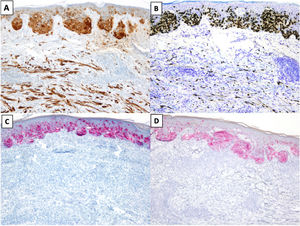 Desmoplastic melanoma (DM) associated with superficial spreading melanoma. A and B, Immunohistochemical staining with S100 (×100) and SOX10 (original magnification ×100). Both stains were positive for DM and melanoma in situ cells. C and D, Immunohistochemical staining with melanoma antigen (original magnification ×100) and human melanoma black 45 (original magnification ×100): Both stains were positive for melanoma in situ cells and negative for DM cells.