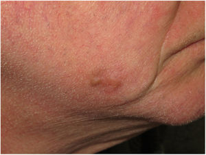 Clinical image of a desmoplastic melanoma (DM) in a 62-year-old man who presented with a progressively growing lesion on his cheek. The lesion was light brown and had a firm scar-like appearance. It was a pure DM with a thickness of 5 mm.