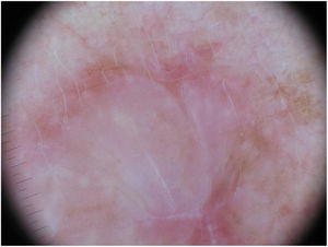 Dermoscopic image of the tumor with a palpable pink component shown in Fig. 4. Observation of a pigment network in several areas of the lesion indicated a melanocytic lesion.
