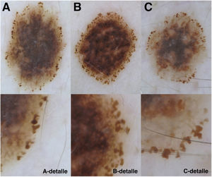 Polarized light dermoscopic images. Lesions with large pigmented peripheral structures and an irregular morphology, similar to SARS-CoV-2 protein spikes. Detailed image of different areas of the lesions are shown in the panels underneath. A, C, Lower right corner. B, Right edge. The histopathologic diagnoses were dysplastic nevus (A), melanoma in situ (B), and superficial spreading melanoma (C).