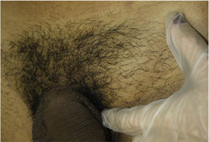 Elastic, nodule in the groin, not adhered to the deep layers, measuring 4 cm, which had appeared 2 weeks earlier, with normal overlying skin.