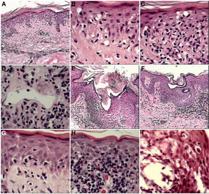 A–C, Little reported but important findings. A, Extensive vacuolization of the basal layer (×10 magnification). B, Detail of vacuolization of the basal layer (×10). C, Vacuolization of the basal layer with effacement of the interface by atypical lymphocytes (×10). D–I, Other frequent findings. D, Vascular ectasia was observed in all stages of MF (×10). E, Dilation with corneal plugging of the infundibula (×10). F, Dilation with corneal plugging of the pores of the acrosyringia (×10). G, Extensive vacuolization of the basal layer (×10). H, Erythrocyte extravasation (×10). I, Spongiosis with microvesiculation associated with eosinophil exocytosis (×10), papules, and erythroderma.