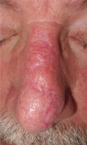 Trapdoor effect after removal of an infiltrating basal cell carcinoma on the tip of the nose. Reconstruction was with a bilobed transposition flap from the nasal pyramid.