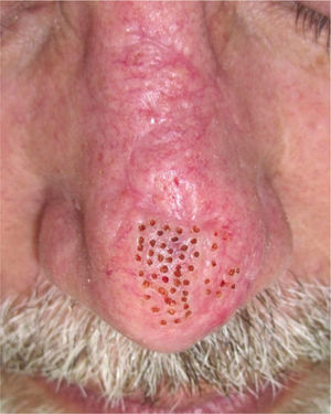 Immediate results after a session of carbon dioxide laser therapy in which several foci were treated, as in a fractional approach. Note the distribution throughout the flap and on the scar borders, but not on the depressed area.