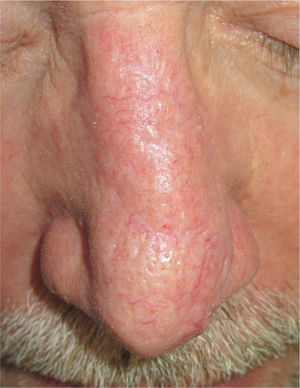 Late outcome after treatment with carbon dioxide laser. Note the improvement in the appearance of the scar, with reduced thickness and erythema.