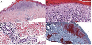 A, Hematoxylin-eosin × 4. B and C, Hematoxylin-eosin × 20. D, CD4 immunohistochemistry × 4.
