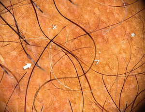 Vainas peripilares en la región proximal del tallo (flecha). Múltiples orificios foliculares vacíos (>) y pelos finos (*). Algunos pelos distróficos (×). En la piel interfolicular se observa un retículo pigmentado fino, presente en la piel de fototipos oscuros.