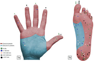 Distribución de los 95 melanomas lentiginosos acrales. En los casos de lesiones subungulares la marca se encuentra sobre el dedo afectado.