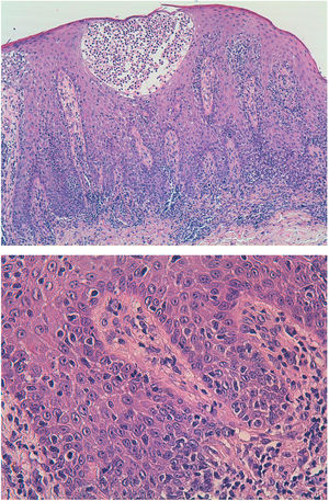 Histological image showing lymphocytic infiltrate throughout the thickness of the epithelium, with a parabasal distribution, marked epidermotropism, and the presence of Pautrier microabscesses. These lymphocytes are also observed in the superficial dermis. The lymphocytes are atypical, with angular, cerebriform, cleft nuclei.