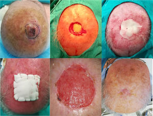 A, Skin tumor measuring >2 cm on the scalp. B, Surgical defect after removal of a tumor involving exposure of the bone. C, Application of bone wax molded into the surgical wound. D, Occlusive compressive dressing with metal staples. E, Complete granulation on withdrawal of bone wax 30 days after the surgery. F, Complete healing of the surgical wound.