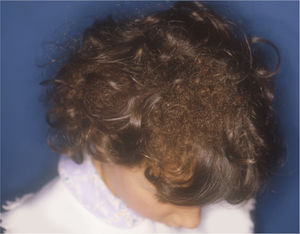 Woolly hair nevus. Tufts of fine, coiled hair among normal-appearing hair.