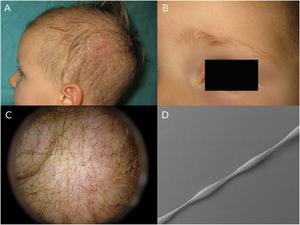 A, Patient with monilethrix. Note the hypotrichosis and papules with perifollicular erythema on the scalp. B, Monilethrix affecting the eyebrows in the same patient. C, Trichoscopic image. D, Electron microscopic image of a hair with monilethrix.