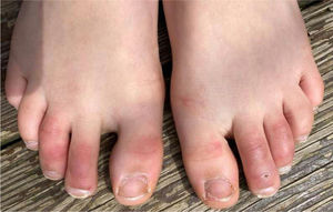 Covid toes in a child.