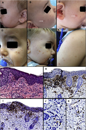 First patient. Clinical presentation: A, Multiple brownish-red papules on the left cheek. B and C, Lesions on the right cheek that took on a more erythematous and edematous appearance on rubbing. D-F, Clinical deterioration of the lesions on the facial area and appearance of lesions on the upper back and arms. Histology: G, Discrete mononuclear infiltrate in the superficial dermis with disperse eosinophils. H, The vast majority of infiltrate cells are positive for CD163. I, Numerous intraepidermal and dermal cells positive for CD1a. J, Many of these are negative for langerin. K, A discrete increase in perivascular mast cells can be observed. (G, HE × 200; H, CD163 × 100; I, CD1a ×100; J, langerin ×400; K, c-kit ×200).