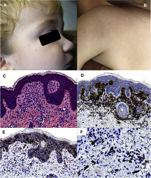 Second patient. Clinical presentation: A and B, Brownish-red maculopapular lesions on the facial area, upper back, and arms. Histology: C, Mononuclear infiltrate in the superficial dermis. D, The dermal population is mostly positive for CD163. E, An unusually high number of cells positive for CD1a is not observed. F, A slight increase in perivascular mast cells can be observed. (D, HE × 200; E, CD163 × 100; F, CD1a ×100; G, c-kit ×400).