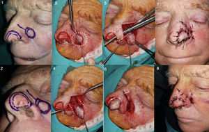 Diseño, realización y postoperatorio inmediato de un CIT paranasal con vascularización aleatorizada (caso 5). 1 y 2: delimitación con márgenes de 3-4mm del tumor (CBC) y diseño de la isla ipsilateral. 3 y 4: labrado de la isla de piel y disección del pedículo subcutáneo. 5 y 6: tras obtener un pedículo de longitud suficiente, se tuneliza la zona interpuesta entre área donante y receptora, y se pasa el colgajo por dicho túnel comprobando así que alcanza la zona receptora sin excesiva tensión. 7 y 8: cierre directo de ambas zonas en este caso con seda trenzada 4/0.