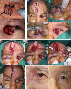 Realización de cirugía de Mohs para extirpación de CBC en canto ocular interno ocular izquierdo (caso 9). 1 y 2: delimitación de márgenes para cirugía de Mohs y defecto tras 3 pases de Mohs. 3: diseño de CIT mediofrontal contralateral con pedículo arteriovenoso guiado por ecografía doppler. 4-6: se realiza reconstrucción de la lamela posterior con injerto dividido de tarso del párpado superior contralateral. 7-10: posteriormente se labra la isla de piel, disecando el pedículo subcutáneo y tunelizando la zona glabelar. Se pasa el colgajo por dicho túnel y se realiza cierre directo en ambas zonas. 11 y 12: resultados postoperatorios con ectropión de párpado inferior a los 3 meses, y tras la reparación del mismo en segundo tiempo quirúrgico.