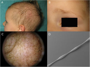 A) Paciente con moniletrix. Se observa hipotricosis y pápulas con eritema perifolicular en el cuero cabelludo. B) Moniletrix en las cejas de la misma paciente. C) Imagen tricoscópica. D) Imagen al microscopio electrónico de un cabello con moniletrix.