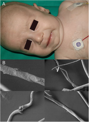 A) Paciente con síndrome de Menkes y kinky hair. B) Estudio con microscopía electrónica de los cabellos del mismo paciente. Se observan pili torti, angulaciones y tricorrexis nodosa.