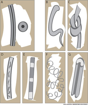 Cabello normal y displasias pilosas. A) Pelo terminal con médula en su interior. B) Cabello en anágeno corto. C) Triconodosis. D) Cabello normal con médula intermitente. E) Pili annulati. F) Cabello lanoso. G) Pili canaliculi et trianguli.