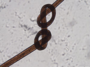 Triconodosis. Se observan dos nudos en el mismo tallo piloso.