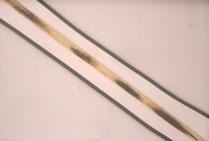 Pili annulati (anillado). Típico aspecto alternante con bandas claras y oscuras como «alfabeto morse».