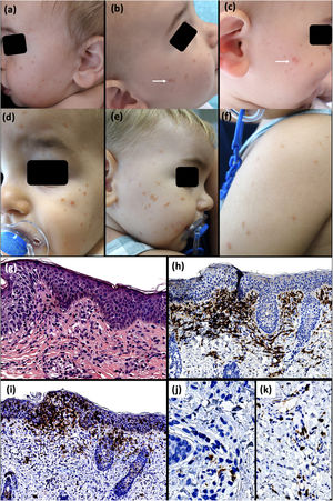 Primer paciente. Clínica: Múltiples pápulas eritemato-marronáceas en la mejilla izquierda (a). Lesiones en la mejilla derecha que, tras el roce, adquirían un aspecto más eritematoedematoso (b y c). Empeoramiento clínico de las lesiones de la zona facial con aparición en parte alta de la espalda y los brazos (d-f). Histología: Discreto infiltrado mononuclear dérmico superficial con dispersos eosinófilos (g). La inmensa mayoría de células del infiltrado son positivas para CD163 (h). Se observan numerosas células intraepidérmicas y dérmicas positivas para CD1a (i), muchas de las cuales son negativas para langerina (j). Se evidencia un discreto incremento de mastocitos perivasculares (k). (g, HE, ×200; h, CD163, ×100; i, CD1a, ×100; j, langerina, ×400; k, c-kit, ×200).