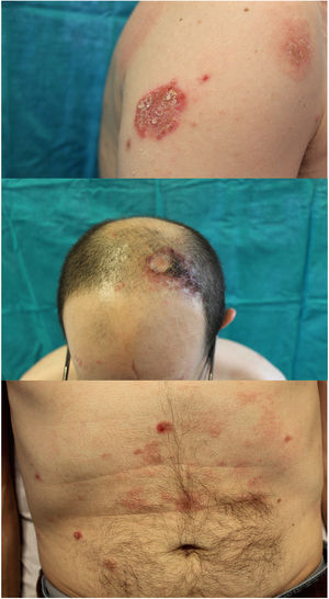 Lesiones eritematodescamativas polimorfas, numulares, anulares, difusas.