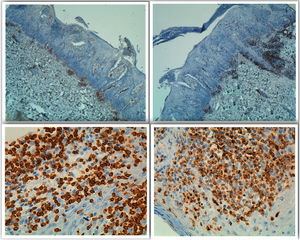 CD4 negativo (superior izquierda), CD8 negativo (superior derecha), CD3 citoplasmático positivo (inferior izquierda), Granzima B positivo (inferior derecha).