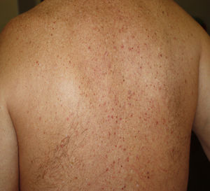 Erupción vesicular (crédito de la imagen: Dr. Alexandre do Campo Simon).