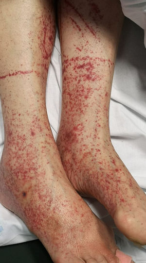 Petequias (crédito de la imagen: Dra. Ana Rodríguez Villa).