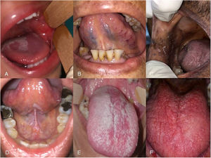 Lesiones orales en pacientes COVID-19. A) Glositis migratoria y petequias en carrillo. B) Varicosidades linguales unilaterales. C) Candidiasis seudomembranosa. D) Leucoplasia en piso de boca y cara ventral de lengua (paciente no fumador) E) Candidiasis seudomembranosa. F) Candidiasis eritematosa.